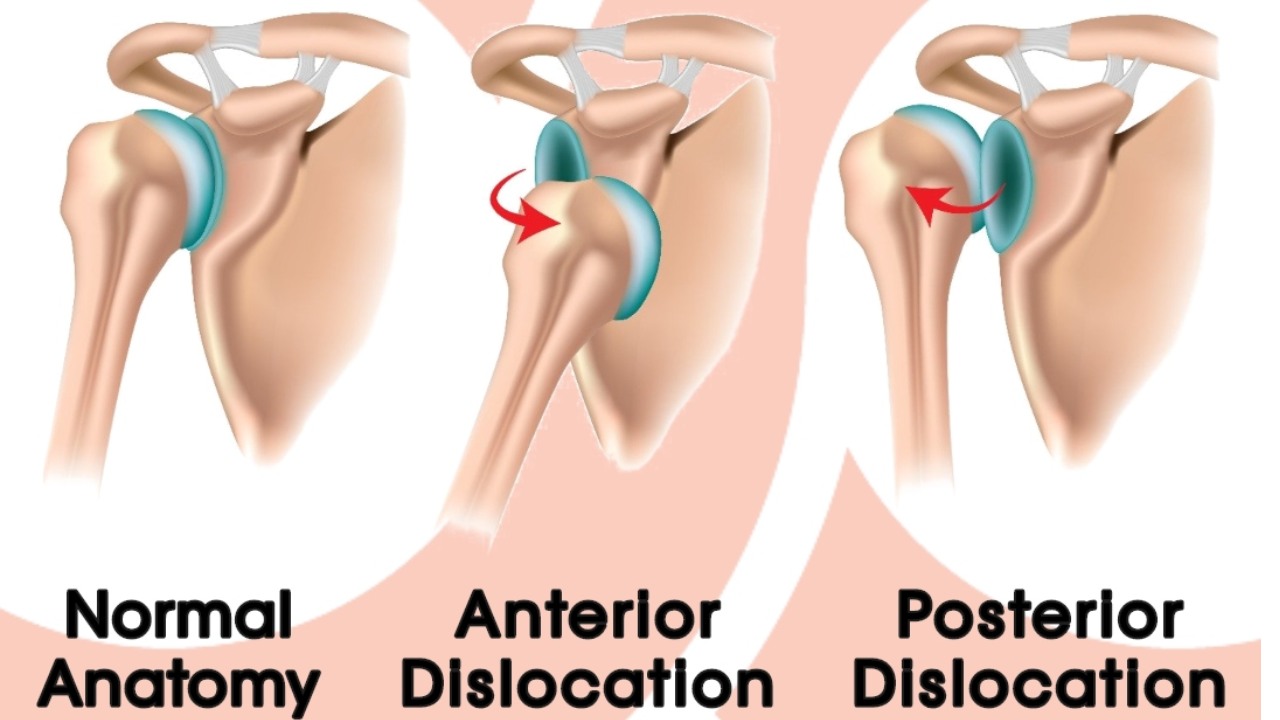 Shoulder Dislocation Blog