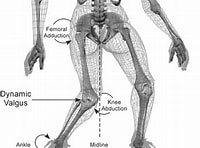 thumbnail_Dynamic knee valgus